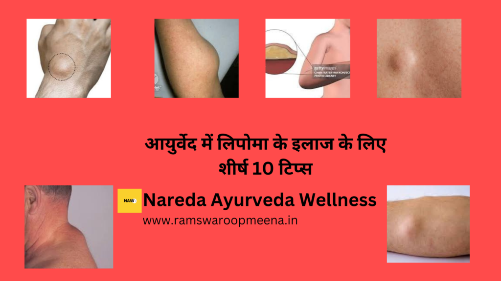 लिपोमा